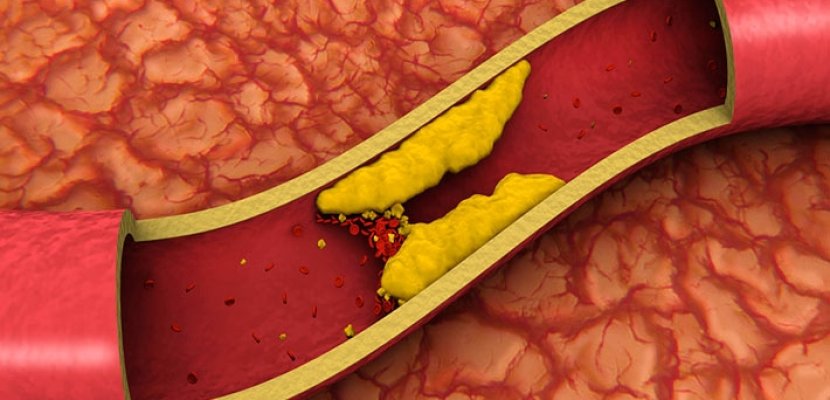 Pericoli del colesterolo e LESSTAT
